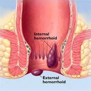 Pile-Hemorrhoids Natural Treatment