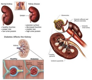 Diabetic Nephropathy Kidney Disease