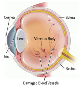 Eye damage-Diabetic Retinopathy