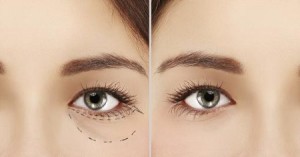 Under Eye Bags and Puffiness Treatment