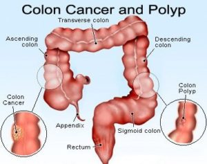 colon_cancer