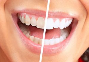 Simple Remedies for Naturally Teeth whitening at Home