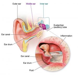 Ear Infections